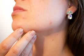 Acne Problems Naples FL