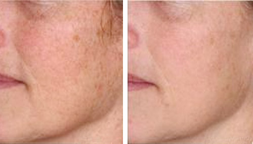 Dermaplaning Naples FL