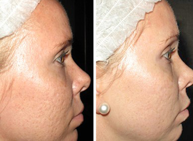 Everything Microneedling Naples